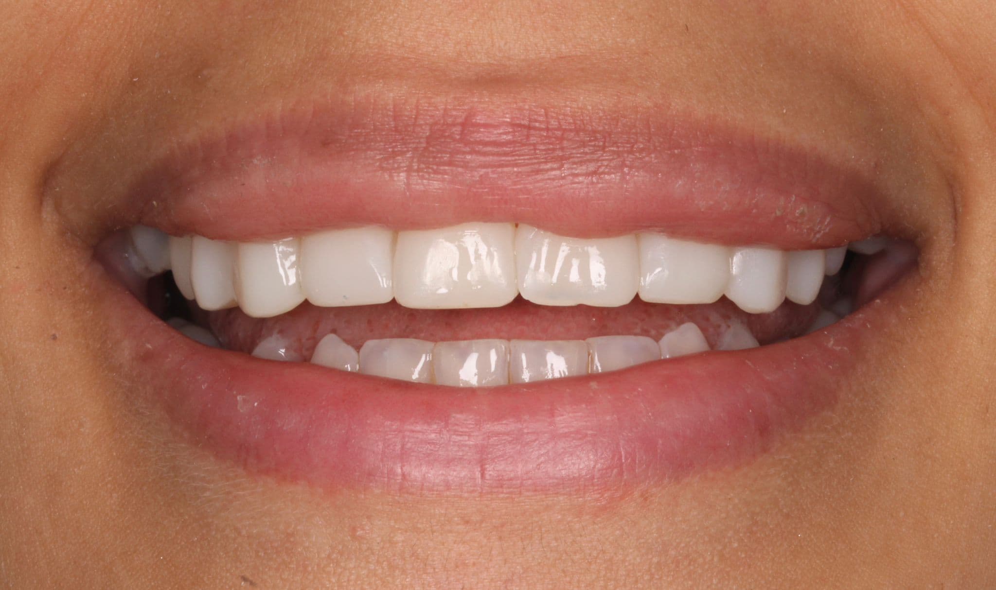 Bio-Emulation & Dental Phobic Dentistry