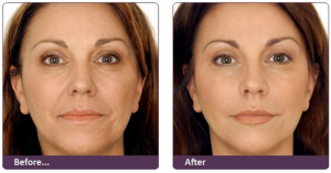 injectables